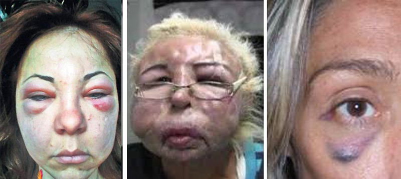 عوارض بوتاکس ۲